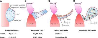 Congenital aortic valve stenosis: from pathophysiology to molecular genetics and the need for novel therapeutics
